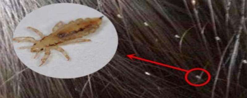 虱子是怎么产生的,虱子是怎么去除 虱子是怎么产生的,虱子是怎么去除